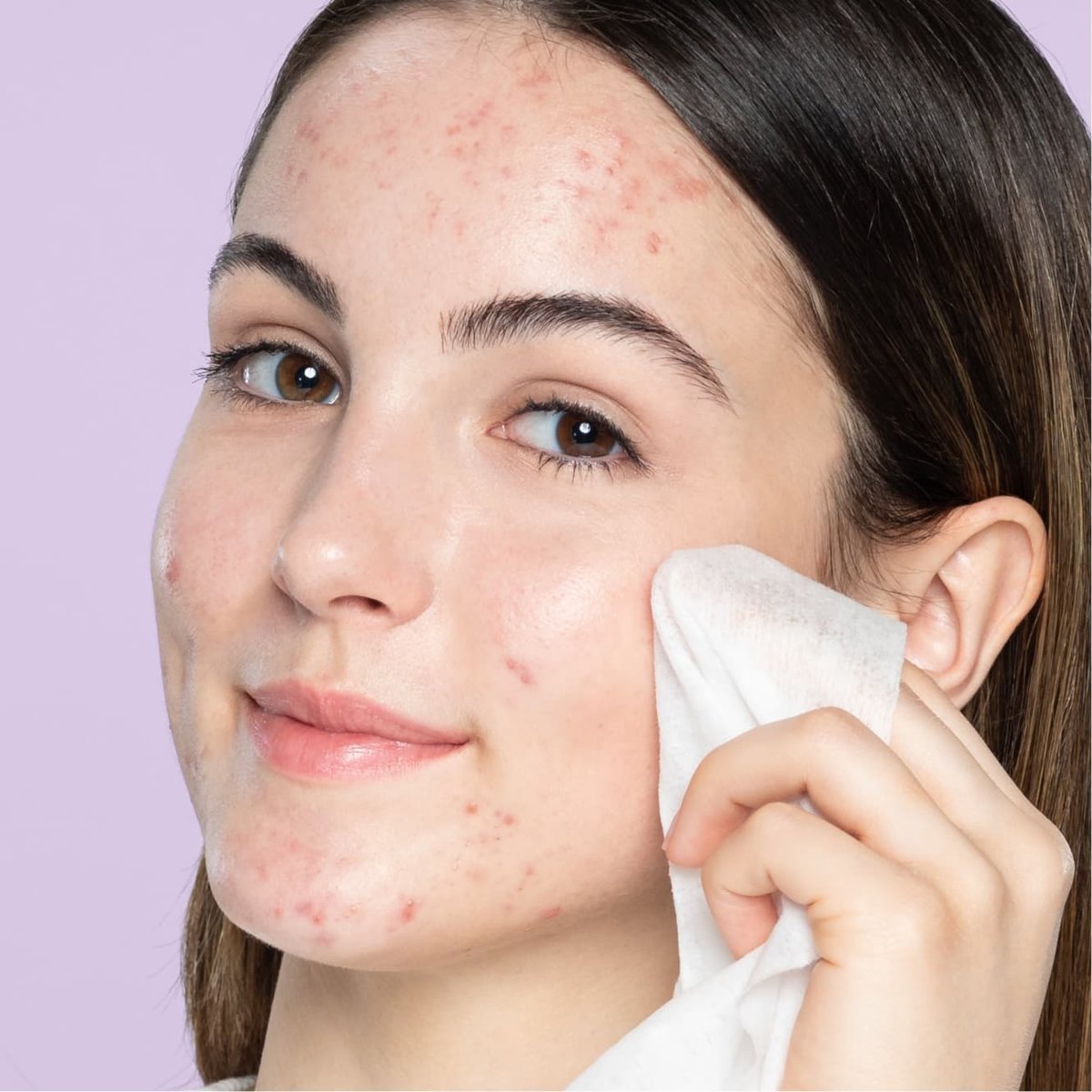 Young teen with brown eyes and brown hair with acne wipes cheek with lemon facial cleansing wipe in front of purple background